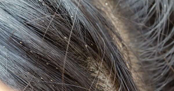 4 remedios naturales para eliminar los piojos del cabello
