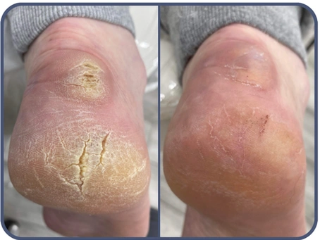 Descubre el Remedio Casero que Puede Poner Fin a tus Talones Agrietados