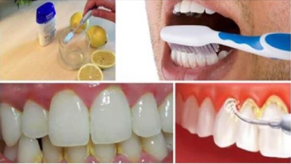 Enjuaga tu boca por 1 minuto con esta combinación y elimina el sarro y la placa acumulada de tus dientes