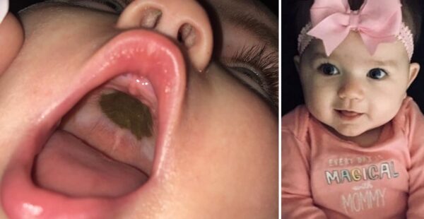 Madré concurre al hospital tras ver mancha en el paladar de su hija y queda avergonzada