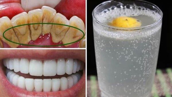 QUITA EL SARRO DE TUS DIENTES Y BLANQUÉALOS CON ESTA SIMPLE RECETA.