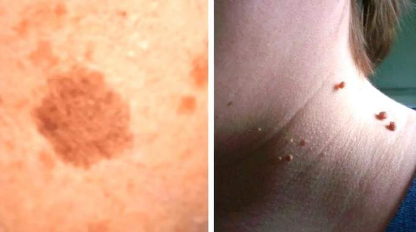 8 rimedi naturali per verruche, fibromi cutanei e macchie senili.