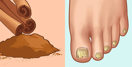 Come sbarazzarsi dei funghi alle unghie con la cannella