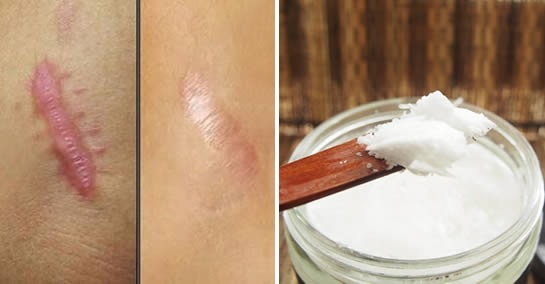 Come usare l’olio di cocco per eliminare smagliature e cicatrici per sempre