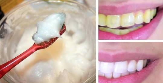 L’ingrediente naturale che sbianca i denti in poche ore