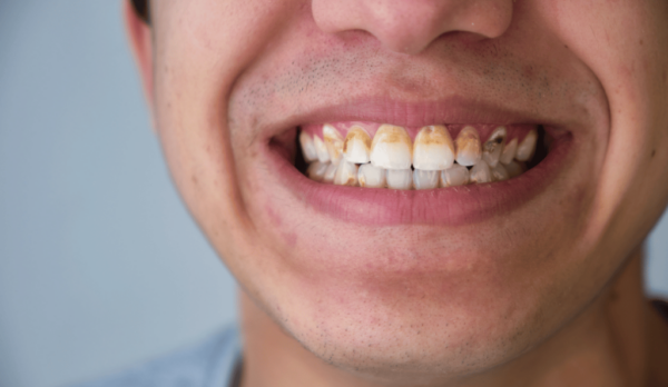3 dicas para remover o tártaro dentário sozinho em casa