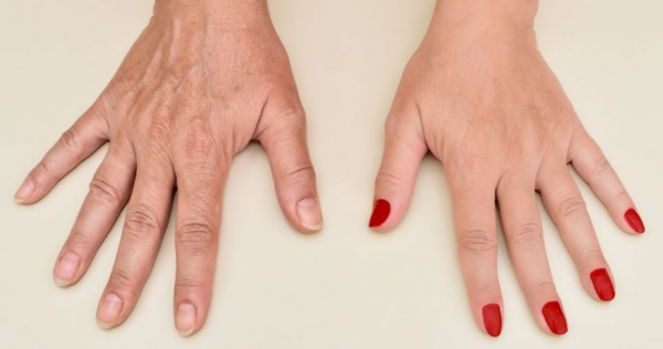 3 tratamentos antirrugas para rejuvenescer as mãos se você tiver mais de 40 anos