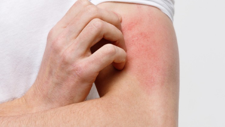 Como se proteger das picadas do pappataci 