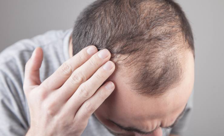 Perda de cabelo