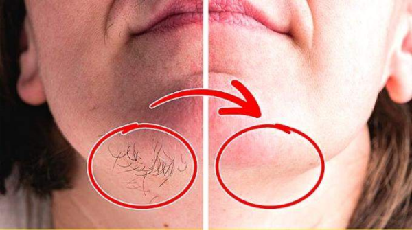 Por que as mulheres têm pelos no queixo? E o que fazer para se livrar disso.