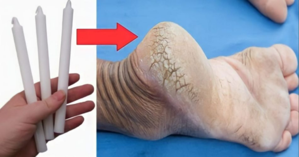 Saltos rachados, com o truque da vela você pode se livrar deles em apenas 1 dia