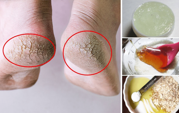 Uma dica antiga para ter pés macios, sem pele seca e rachaduras