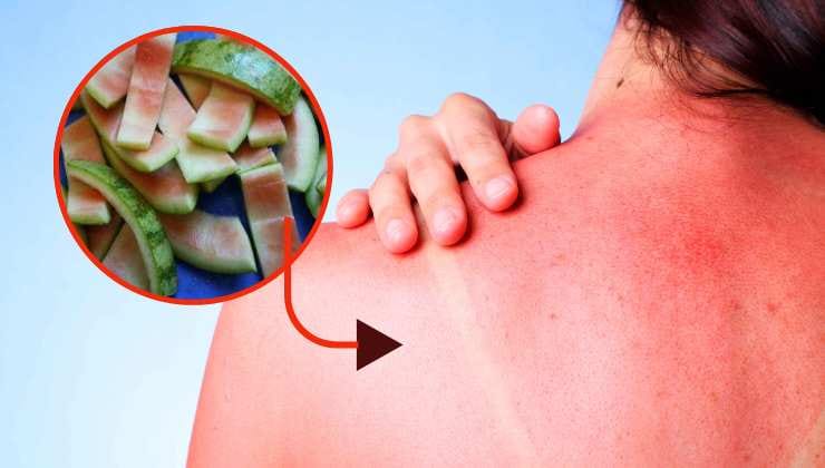 Cascas de melancia para queimaduras solares Cascas de melancia para queimaduras solares