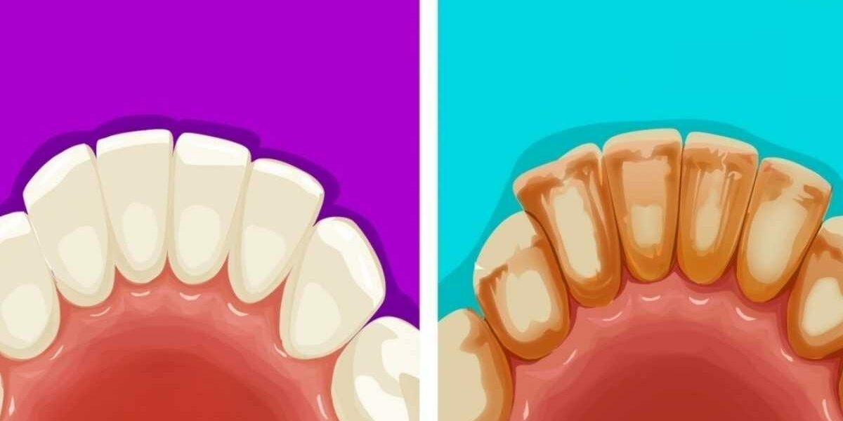 3 natürliche Mittel zur Entfernung von Zahnstein