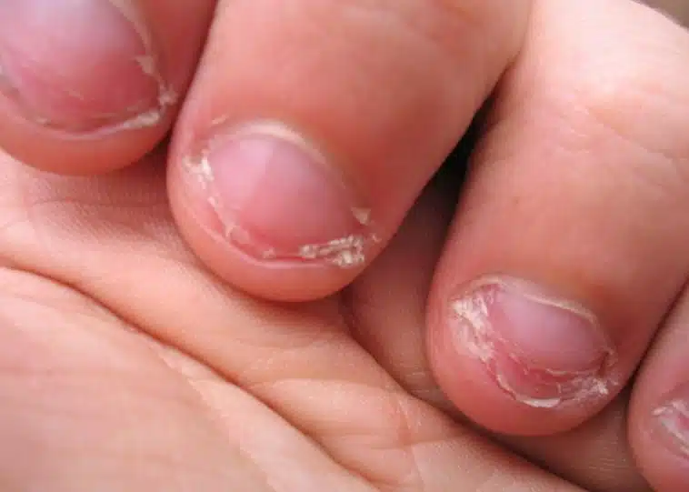 5 Tipps, damit Sie nie wieder an den Nägeln kauen