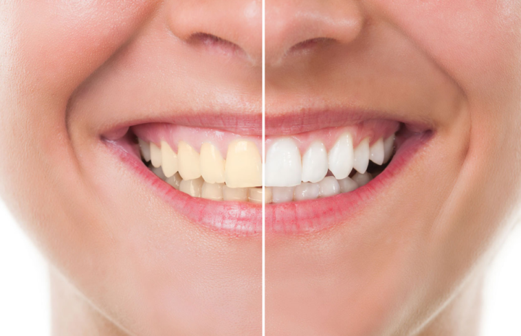 5 gute Gewohnheiten für weißere Zähne