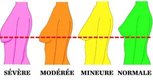 7 sichere Möglichkeiten, Ihre Brüste nach dem Abnehmen zu straffen