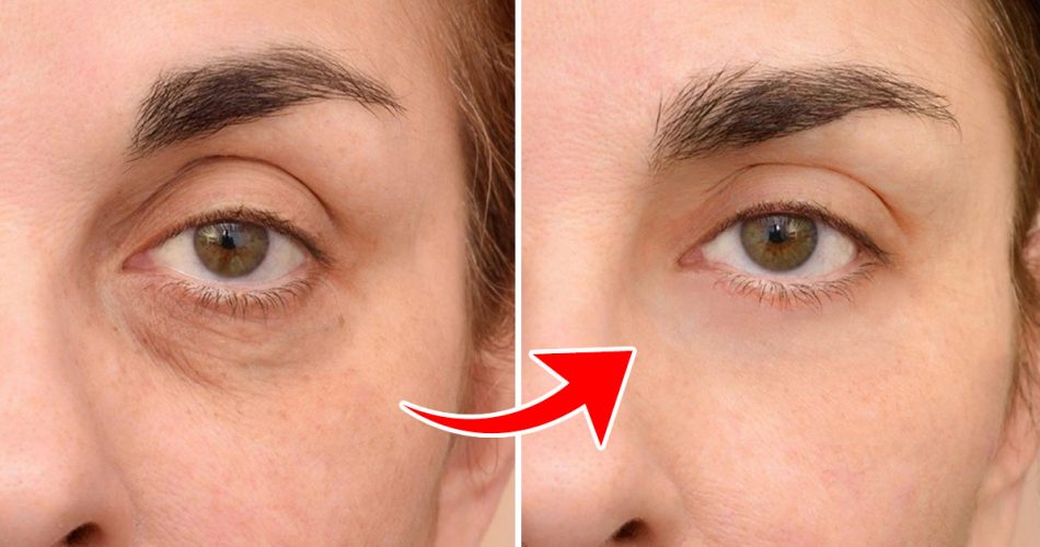 Das Geheimnis gegen Augenringe und Tränensäcke liegt im Kühlschrank