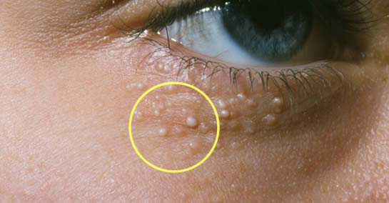 Mittel zur Beseitigung von Milien, den lästigen weißen Kugeln auf der Haut