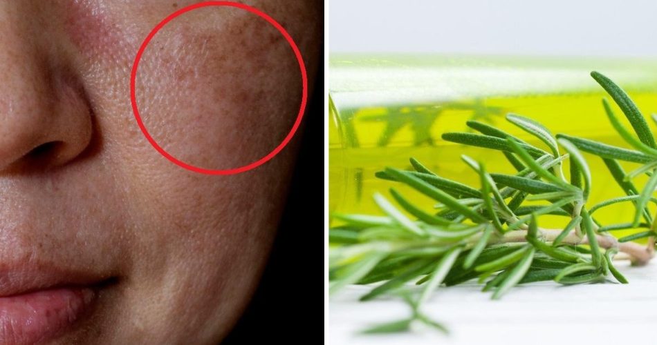 Rosmarin-Tonikum zur Beseitigung von Falten und Hautflecken, damit die Jahre nicht über Sie kommen