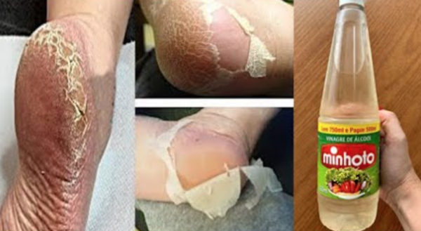 Acabe com as rachaduras nos pés de maneira bem simples
