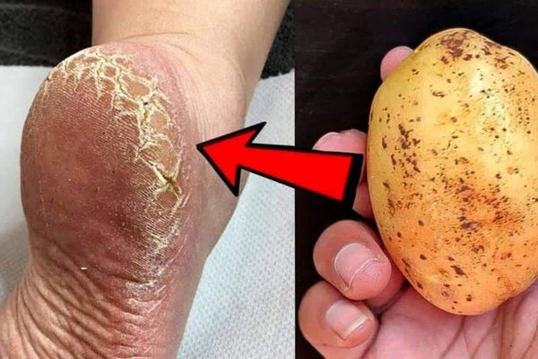 Como acabar com as rachaduras dos pés de um jeito surpreendente sem precisar comprar cosmético caro