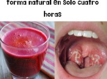 Como deshacerse de las informaciones de garganta de forma natural