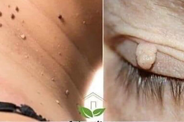 ELIMINA tus VERRUGAS en MENOS de 1 DÍA