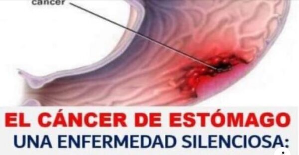 El cáncer de estómago: detectando los primeros síntomas para una detección temprana