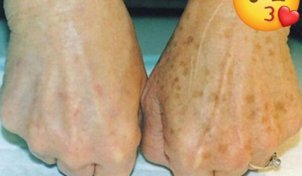 Esas eran mis manos 15 días antes de aplicar este remedio natural. mi cara también quedo sin manchas.