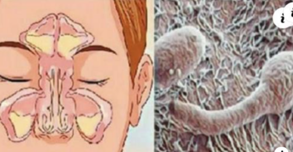 La conexión sorprendente entre la nariz obstruida y el intestino: ¿Rinitis o sinusitis?