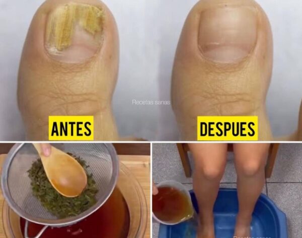 MÉTODO NATURAL PARA ELIMINAR LOS HONGOS DE LAS UÑAS.
