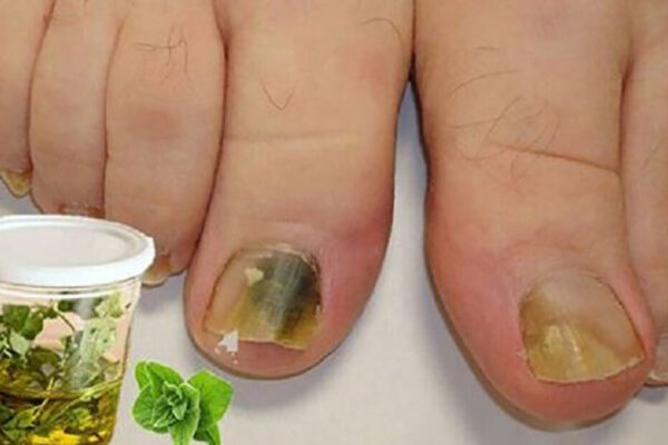 Orégano Para Los Hongos Tu Mejor Aliado