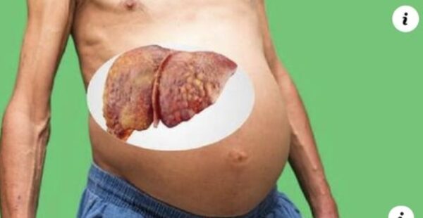 Síntomas de hígado graso y como limpiarlo