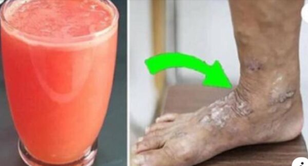 Sufres de dolor por mala circulación y retención de líquidos