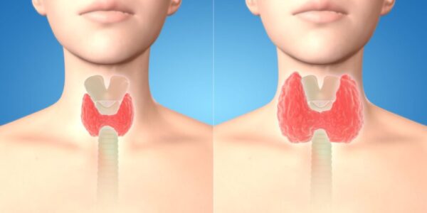 10 signes que vous souffrez d’un problème de thyroïde et voici les solutions