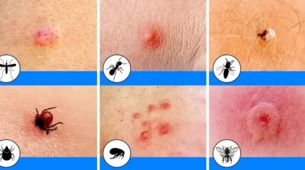12 piqûres d’insectes communes et comment reconnaître chacune d’elles
