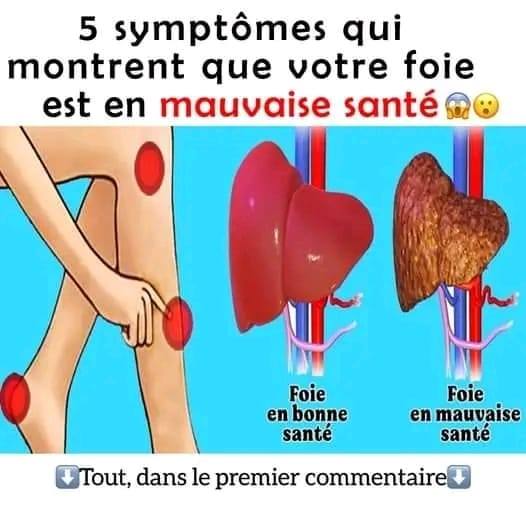 5 Signes que votre foie est toxique et vous fait gagner du poids