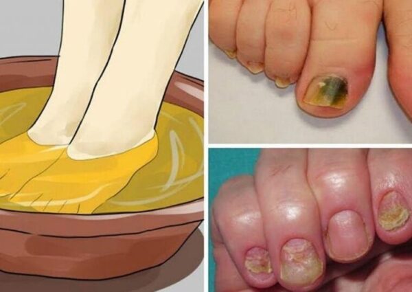 5 remèdes naturels pour soigner la mycose des ongles