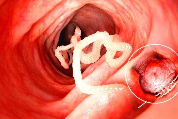 Des vers intestinaux que l'on peut faire disparaitre avec des remèdes de grand-mère