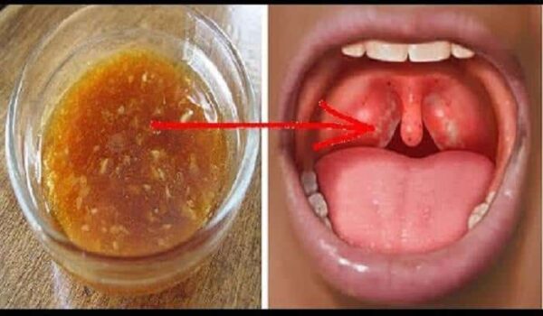 Angine : 32 traitements naturels pour se débarrasser d’un mal de gorge