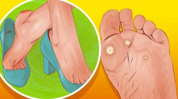 CORS AU PIED VOICI 4 PLANTES POUR VOUS EN DÉBARRASSER