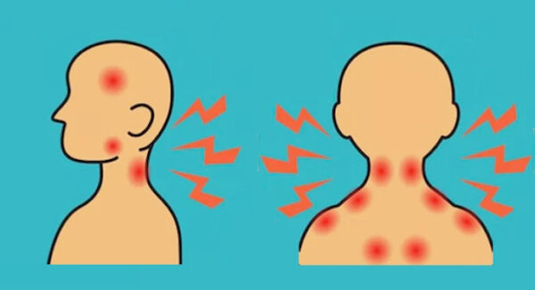 Ce syndrome est souvent confondu avec d’autres maladies rares comme la fibromyalgie, le syndrome d’Ehlers-Danlos.