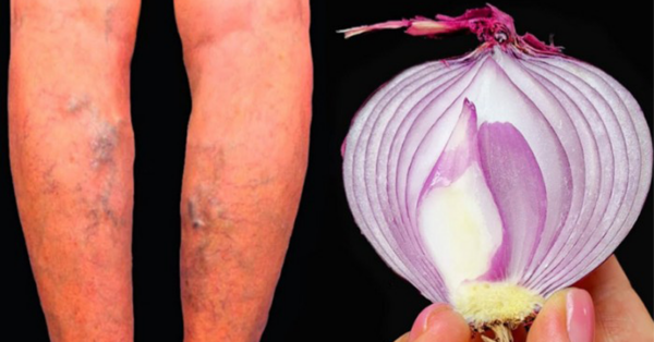 C’est un tueur de varices ! Efface les varices comme par magie.