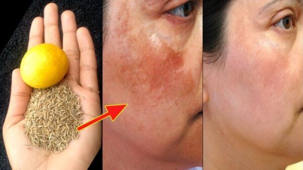 Comment Faire Partir les Taches Brunes sur le Visage Naturellement