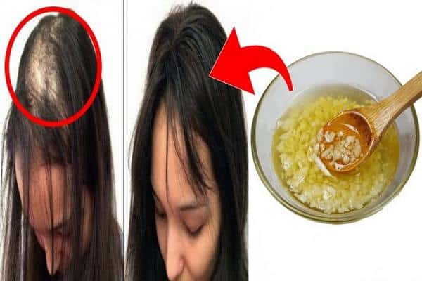 Comment Utiliser L’oignon Et L’ail Pour Prévenir La Chute Des Cheveux Et Stimuler La Pousse