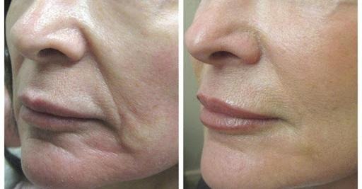 Comment préparer un masque au collagène avec un “effet tenseur” contre les rides