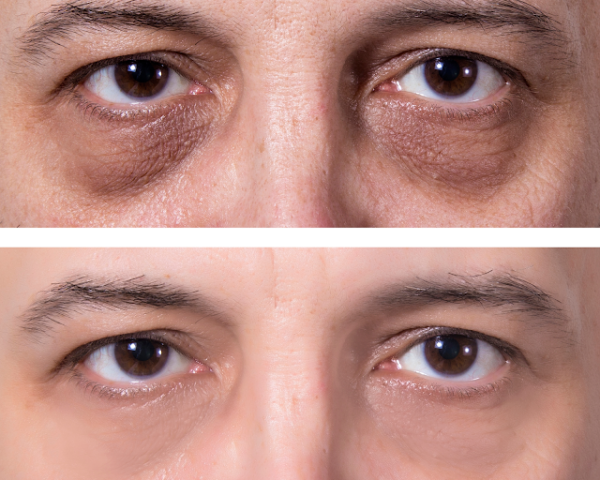 Comment se débarrasser des cernes ?