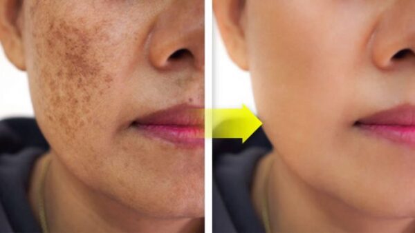 Comment utiliser le persil sur le visage pour éliminer les imperfections, les rides et l’acné