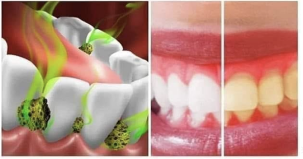 Dites adieu aux taches et à la décoloration des dents grâce au curcuma.